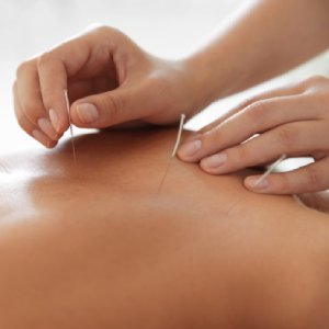 Acupuncture | Physiotherapy On Wheels - Mississauga, Toronto, Brampton & the GTA